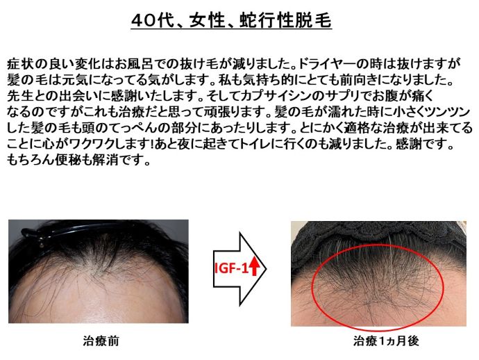 円形脱毛症　病院